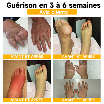 Boutique officielle en France 🇫🇷 Purelora® Bee Venom Pain Relief Joint Repair Cream 🐝🐝 (Soulagement rapide de la douleur · Réduction de l’inflammation · Soutien des articulations et des os)