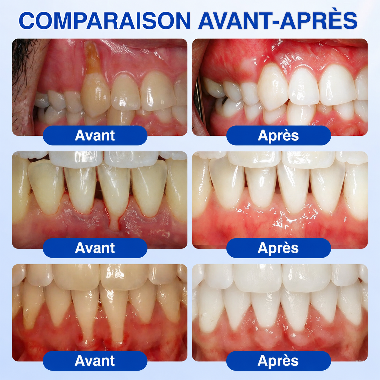 💎🦷𝑷𝒖𝒓𝒆𝒍𝒐𝒓𝒂® 𝑮𝒖𝒎𝑹𝒆𝒗𝒊𝒗𝒆 𝑮𝒆𝒍 𝒅𝒆 𝑹é𝒑𝒂𝒓𝒂𝒕𝒊𝒐𝒏 𝑷𝒂𝒓𝒐𝒅𝒐𝒏𝒕𝒂𝒍𝒆🦷