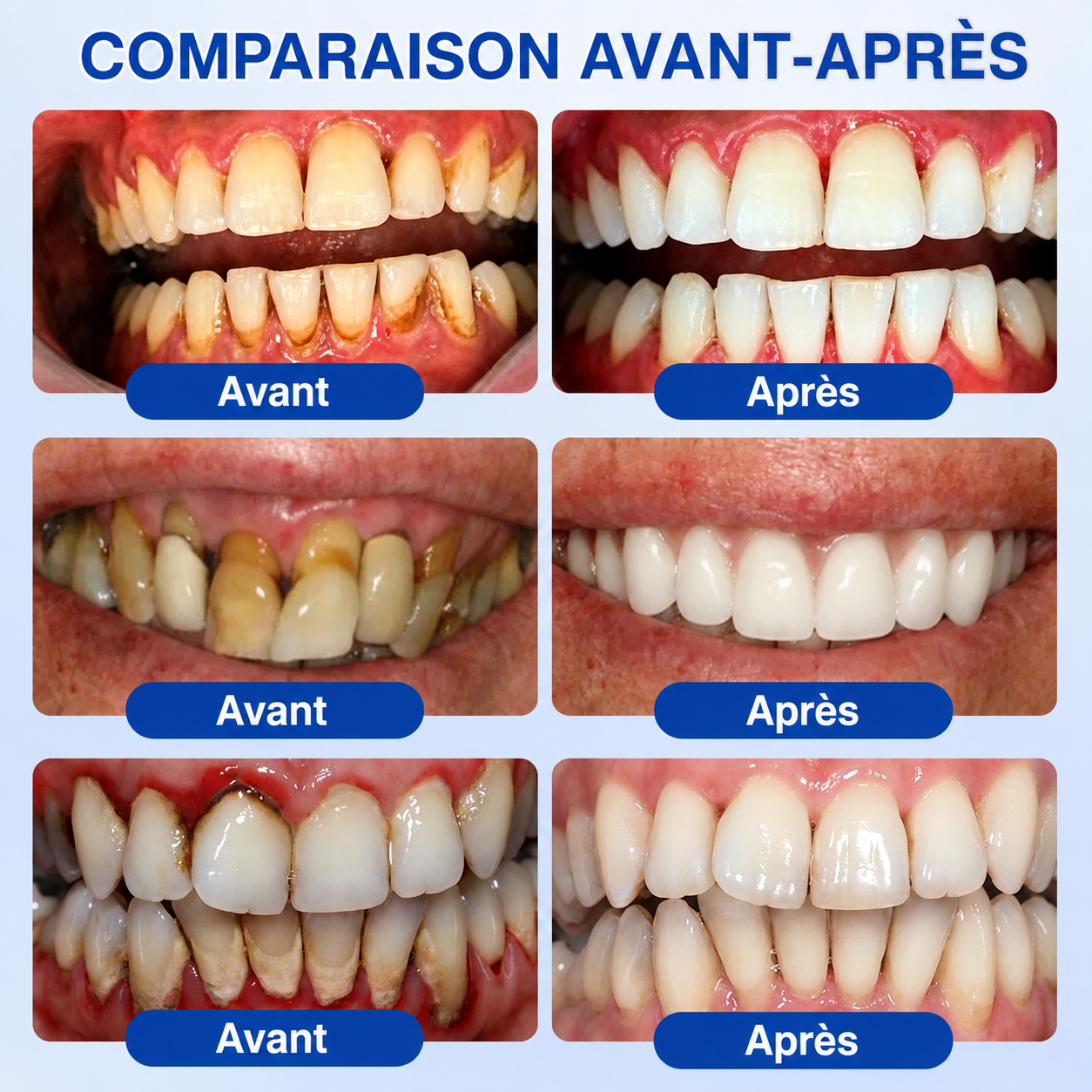 💎🦷𝑷𝒖𝒓𝒆𝒍𝒐𝒓𝒂® 𝑮𝒖𝒎𝑹𝒆𝒗𝒊𝒗𝒆 𝑮𝒆𝒍 𝒅𝒆 𝑹é𝒑𝒂𝒓𝒂𝒕𝒊𝒐𝒏 𝑷𝒂𝒓𝒐𝒅𝒐𝒏𝒕𝒂𝒍𝒆🦷